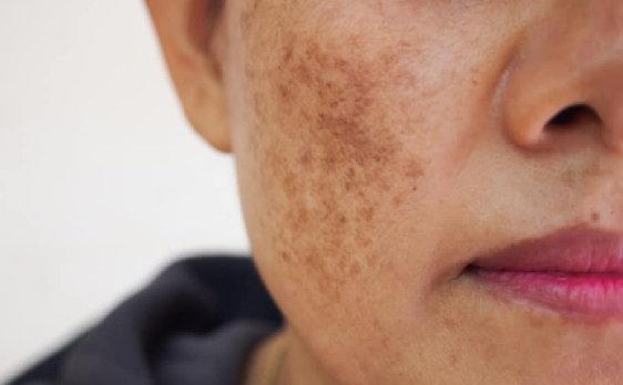 BioCare Arbutin Serum