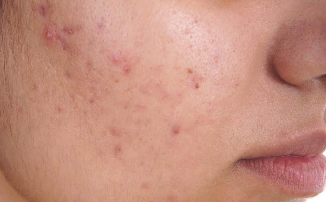 BioCare Premium Anti-Acne and Hormone Balance Gummies