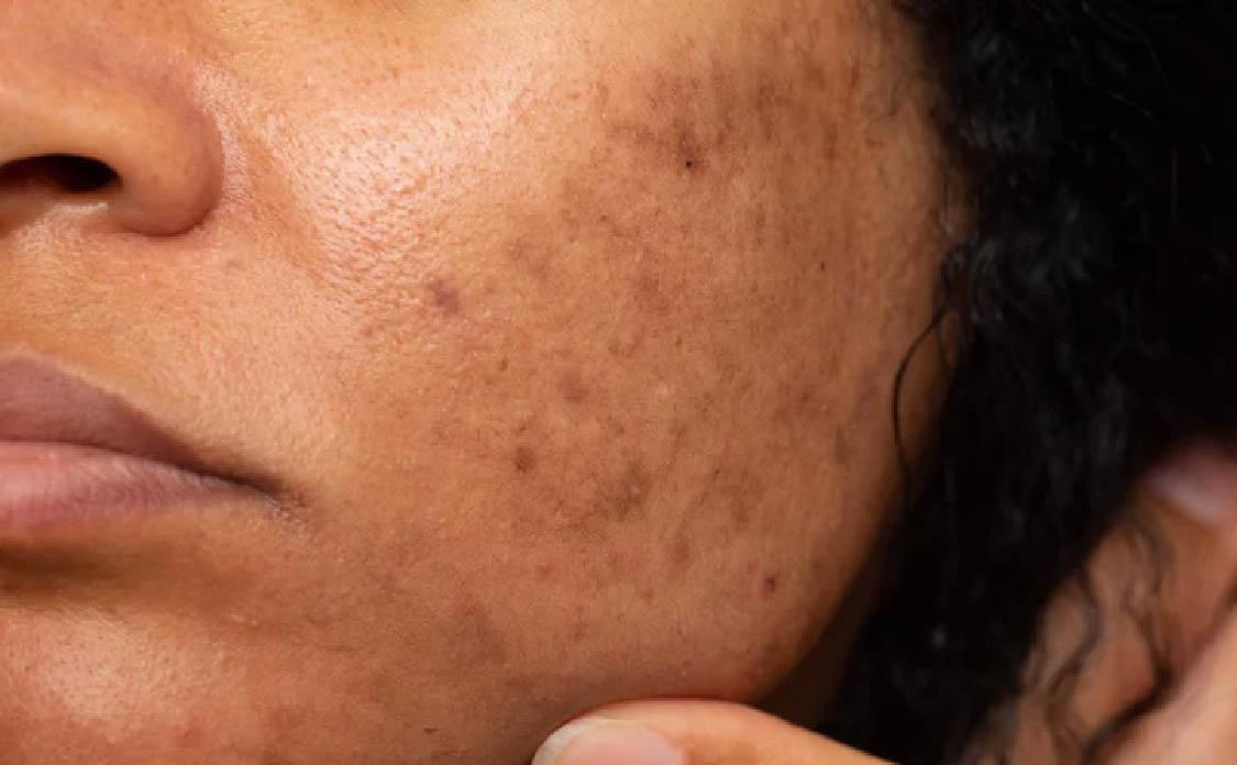 BioCare Premium Skin Whitening Gummies