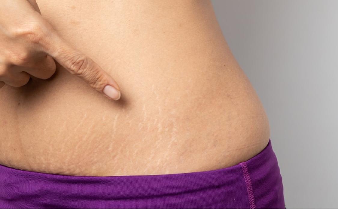 Mama’s Stretch Mark Oil